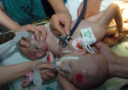 ,,,conjoined twins,,,