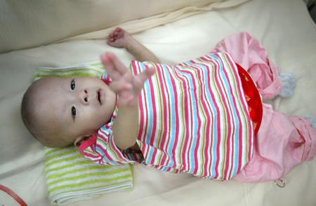 ,,Hu Jingyi,,,conjoined twins,,,
