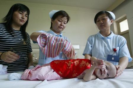 ,,Hu Jingyi,,,conjoined twins,,,