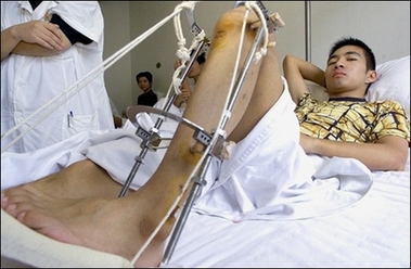 A patient recovers after having an operation to lengthen his leg at a hospital in China's eastern city of Hangzhou in Zhejiang province in August 2002. China has banned leg-lengthening surgery that a largely unregulated beauty industry has been offering to customers who want to be taller.(AFP