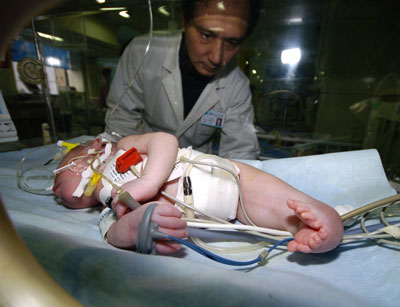 Baby Born Weeks on Maomao The 10 Day Old Baby Who Was Born With Her Legs Joined Together