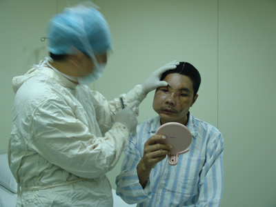 China's first facial transplant patient back at home