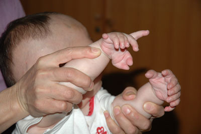 Boy with multiple fingers and toes receives treatment