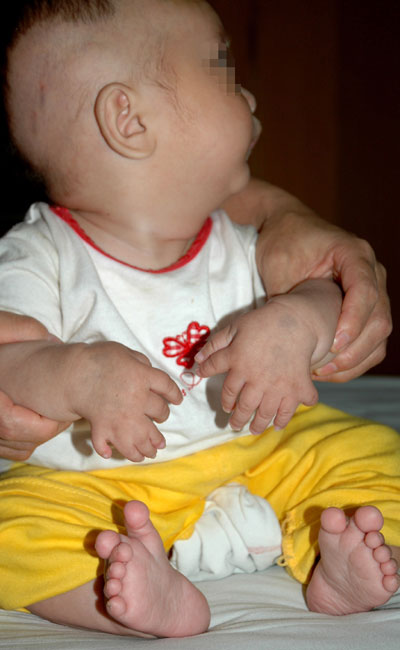 Boy with multiple fingers and toes receives treatment