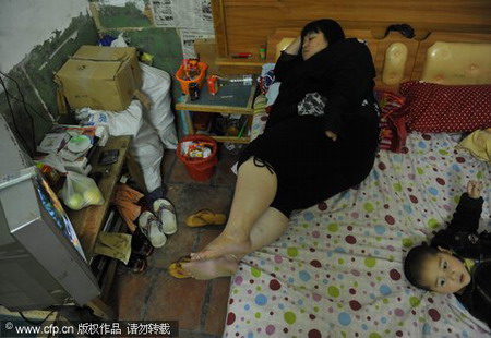 Overweighted woman receives surgical treatment