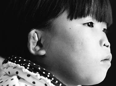 Girl's face reconstructed after years of abuse