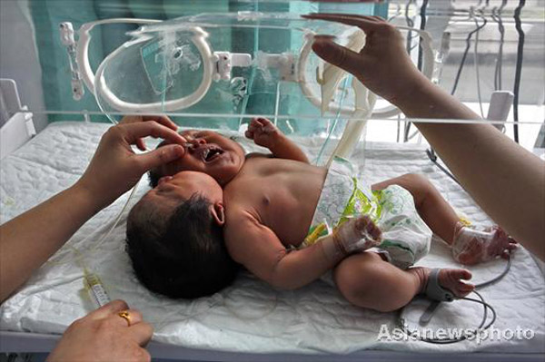 Conjoined twins that resemble a baby girl with two heads born on May 5 receive treatment at a hospital in Suining, Sichuan province, May 9, 2011. Weekly Photos: May 9 - May 15
