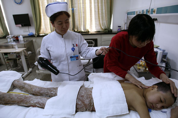 Young fire victim undergoing treatment