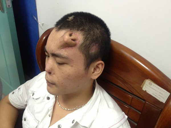 Chinese doctor builds new nose on man's forehead