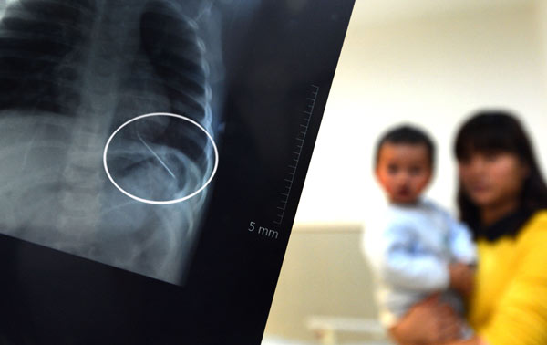 Crying toddler had 5-cm needle inserted in his lung