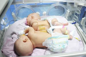 Medical team successfully separates conjoined twins