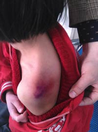 Girl's severe beating part of a 'common' pattern