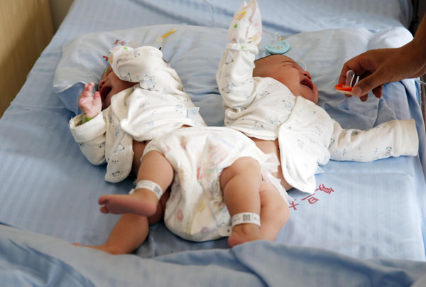 3-D technology used in twins' separation