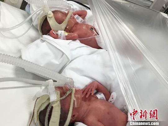 Identical natural quadruplets born in Shanghai: 1 in 13 million