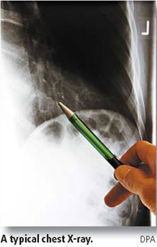 X-rays: Scanning for damage has its risks too