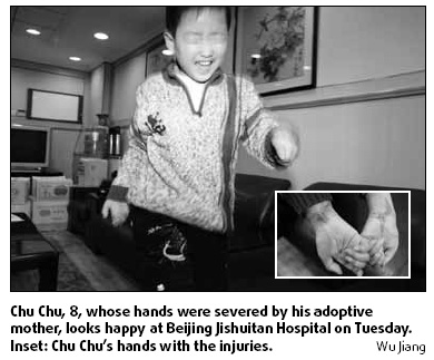 Boy with cut-off hands recovering