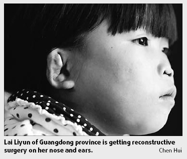 Girl's face reconstructed after years of abuse