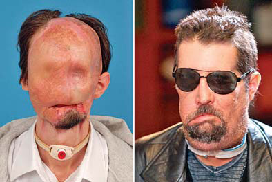 'Handsome' face transplant patient makes appearance
