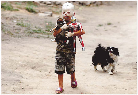 Burned boy faces 10 yrs behind his mask: family