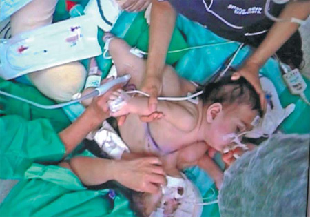 Doctors separate conjoined twins in 20-hour operation