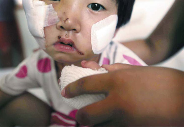 Girl mauled by mastiff in Beijing needs 200,000 yuan for surgery