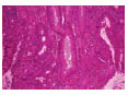What is colorectal cancer and what can you do to prevent it