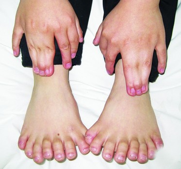 6岁孩长31根手指脚趾 超吉尼斯世界纪录(图)