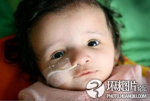 难以置信的罕见怪病：忘记呼吸 静电过敏 听闹钟响心脏停跳