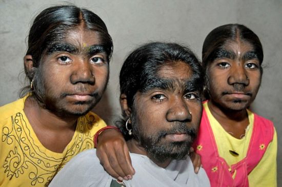 印度三姐妹患怪病全身长毛 外形似狼人