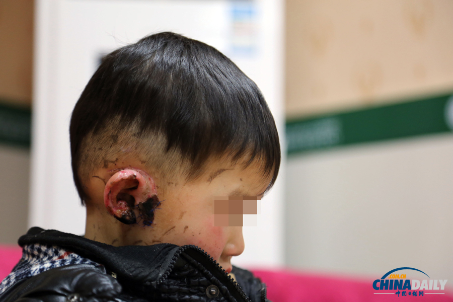 6岁男童惨遭婶婶割耳续：有医院免费为他造左耳
