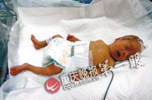 袖珍双胞胎姐妹悲喜两重天 放弃哪个都舍不得
