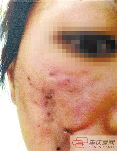 重庆美女手术后脸蛋肿胀发紫 整形门诊被判补偿12万5