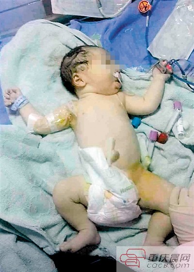重庆一新生儿患上罕见病 出生后极重度贫血 浑身雪白色