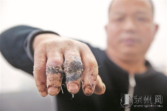 患者投诉医院中指无名指错接 医院：要等鉴定结果