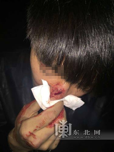 走路打闹撞上盒饭车 鼻骨被老板打折