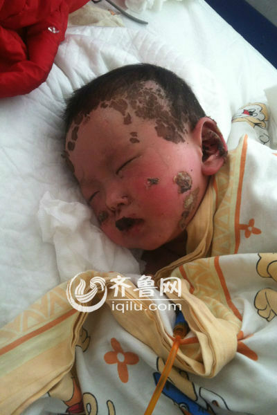 山东1岁男童皮肤溃烂续：病情趋于好转 脸上开始结痂