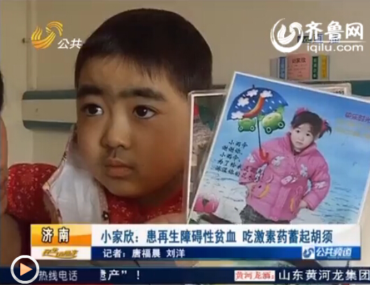 济宁5岁女童患再生障碍性贫血 吃激素药长出胡须