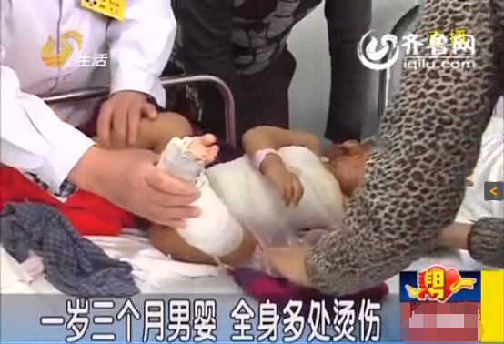 枣庄一岁男婴被滚烫热水从头浇下 大面积严重烫伤