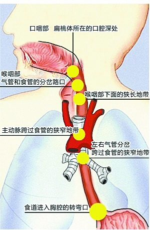 男子鱼刺卡喉身亡 医生: 吞饭喝醋等土方法