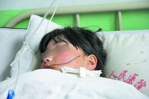 女中学生被同学用刀毁容 伤口长达13厘米(图)