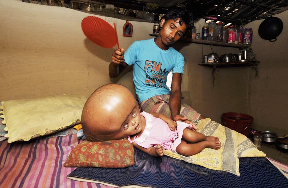 印度女童患脑积水 外形犹如外星人ET