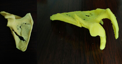 光明:全市首例3D打印技术助力创伤骨科手术成