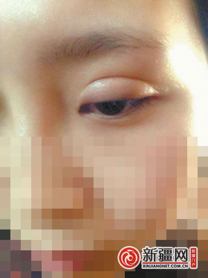 乌鲁木齐一女孩割双眼皮后肿了9个月