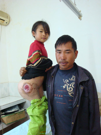 瑶家囡身长巨瘤八年引发“爱心接力”(组图)