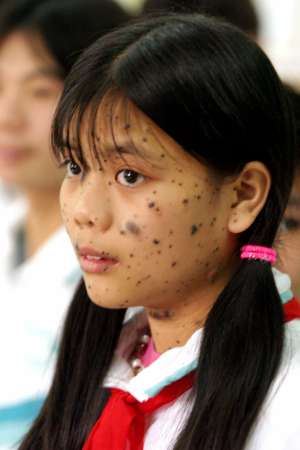 A Vietnamese Agent Orange victim looks on at Hoa Binh (Peace) village, a hospice for Agent Orange victims in Hanoi on December 14, 2004. A federal judge on March 11 dismissed a lawsuit that accused chemical companies of committing war crimes by supplying the U.S. military with Agent Orange in the Vietnam War, saying they did not violate U.S. or international law. Picture taken on December 14, 2004. REUTERS/Kham 