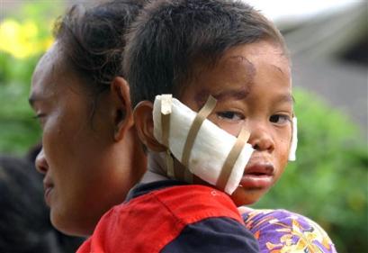 Ramadhan, 4, who was severely injured in Monday's earthquake, is carried by his mother Yasmina, Wednesday, March 30, 2005, in Gunung Sitoli on Nias Island, Indonesia. A massive earthquake late Monday killed hundreds and sparked fears of another tsunami in the region. (AP Photo/Suzanne Plunkett) 