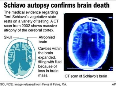 Graphic shows CT scan of Terri Schiavos brain. (AP