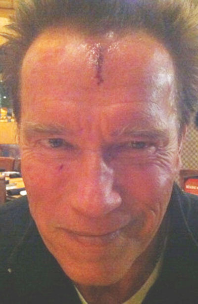 Arnold Schwarzenegger injured on set