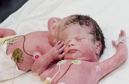 This handout picture shows conjoined twins, Krista (R) and Tatiana Hogan, at the BC's Women's Hospital and Health Centre in Vancouver, British Columbia, October 26, 2006. The twin girls joined at the head are doing well a day after their birth, but doctors said on Thursday it could be three or four months before they will know if they can be separated.