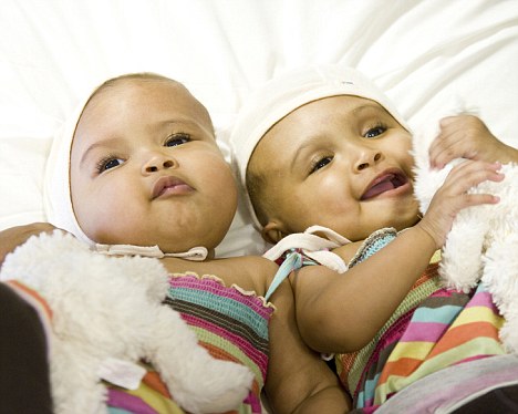 英国医生成功分离头部相连双胞胎女婴 属世界首次